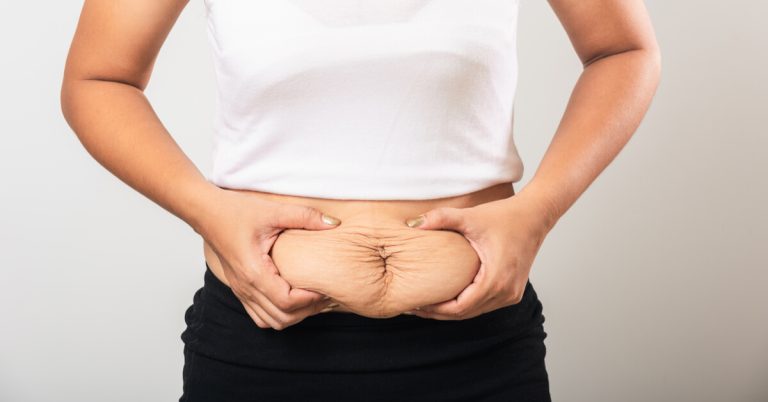 What Is Diastasis Recti? How Is It Treated?