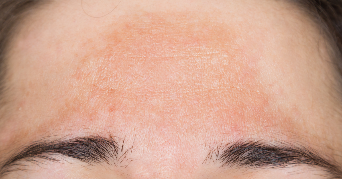 Changes in the Skin During Pregnancy