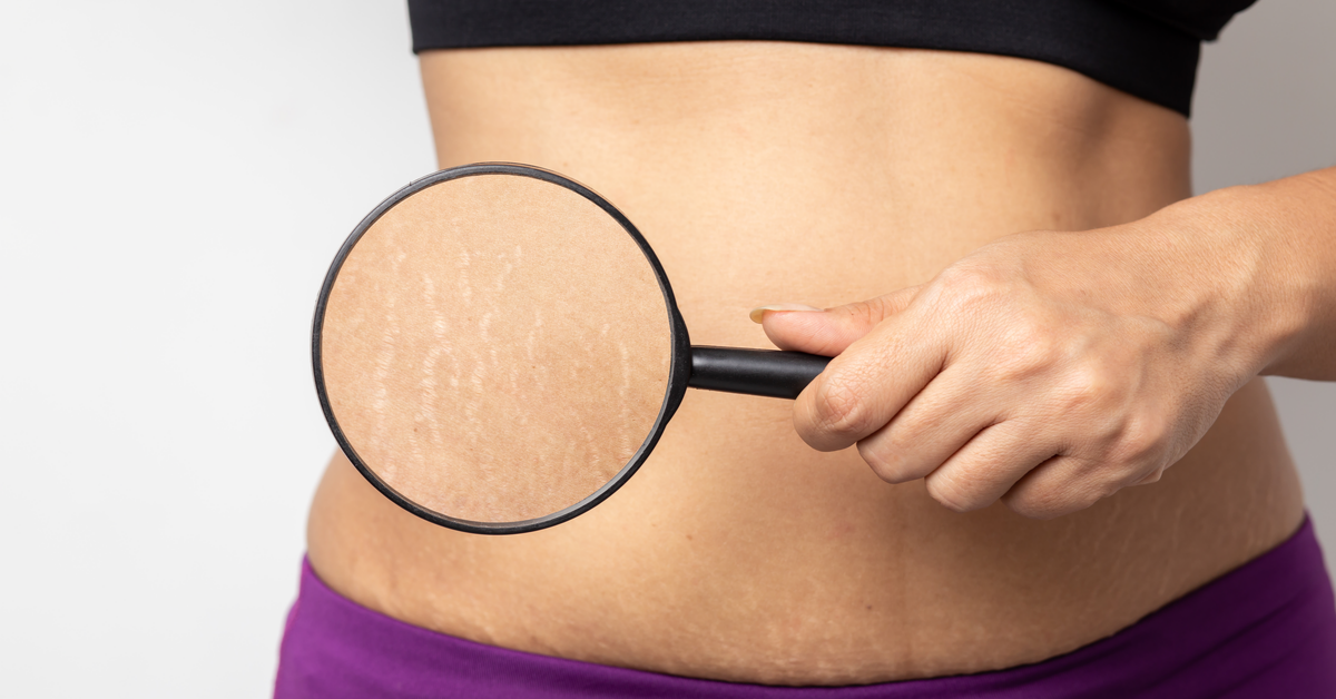 Changes in the Skin During Pregnancy