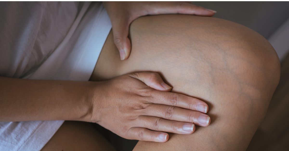 Changes in the Skin During Pregnancy