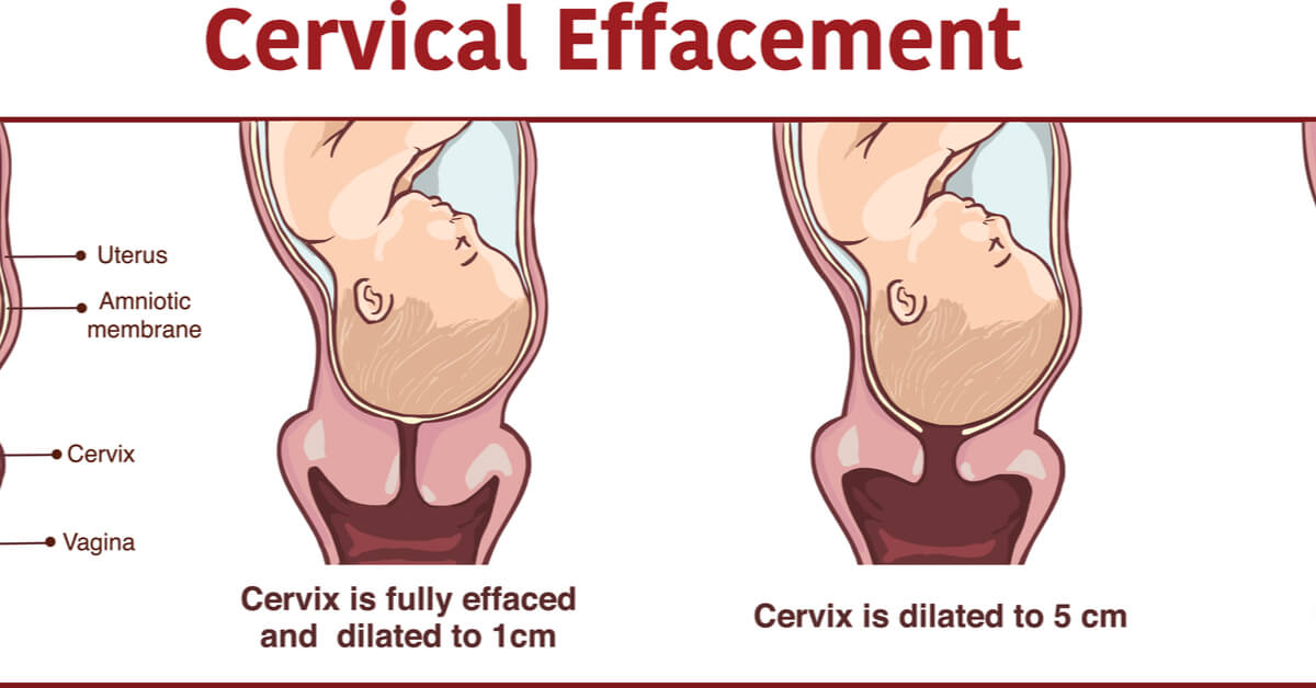 What Does Cervical Opening Mean in the Delivery Process?